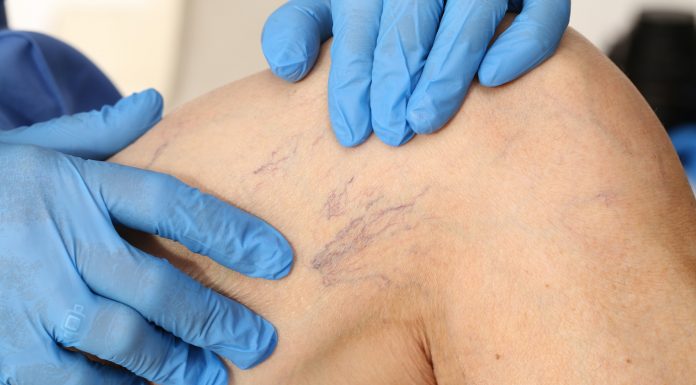 5 infuzii diuretice care te ajuta sa lupti impotriva venelor varicoase