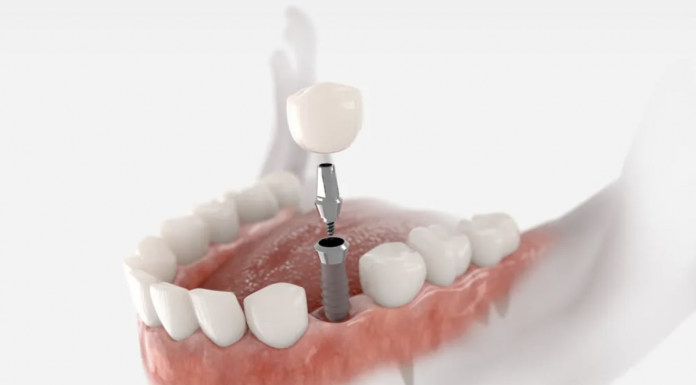 Implanturi dentare All on 4 sau All on 6: secretul pentru o dantură completă și durabilă